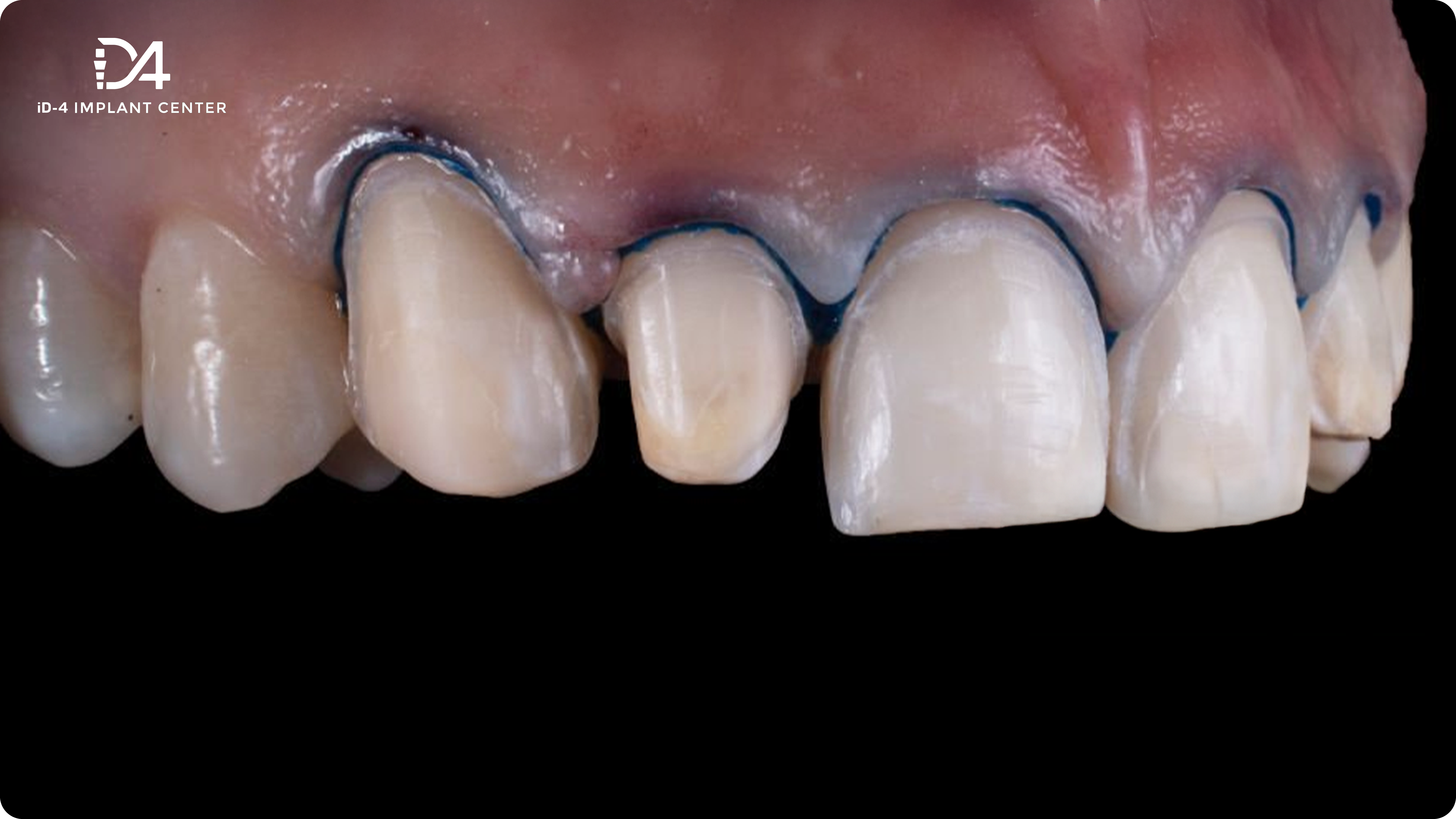 veneer-su-0001@3x