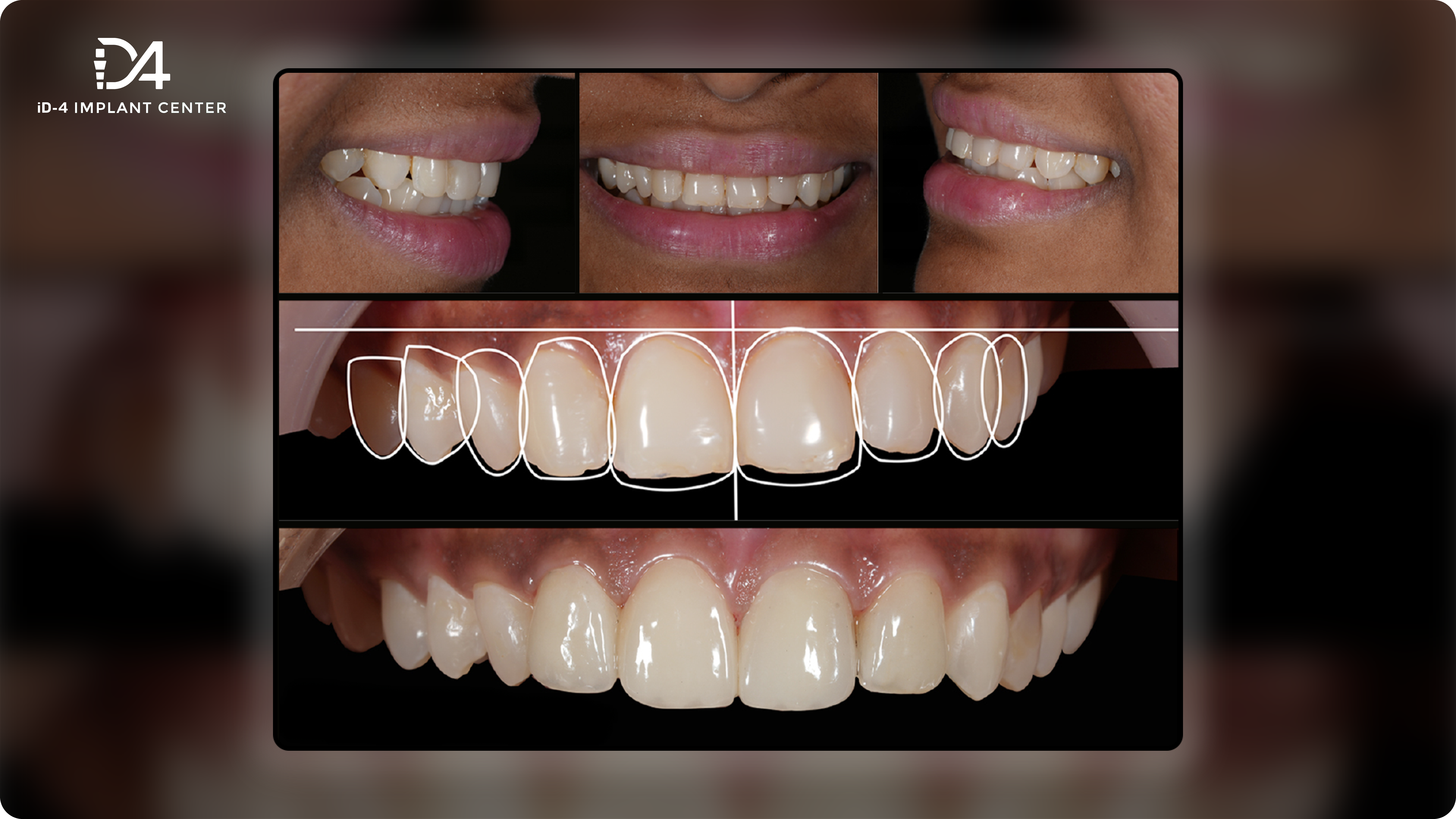 veneer-su-001@3x